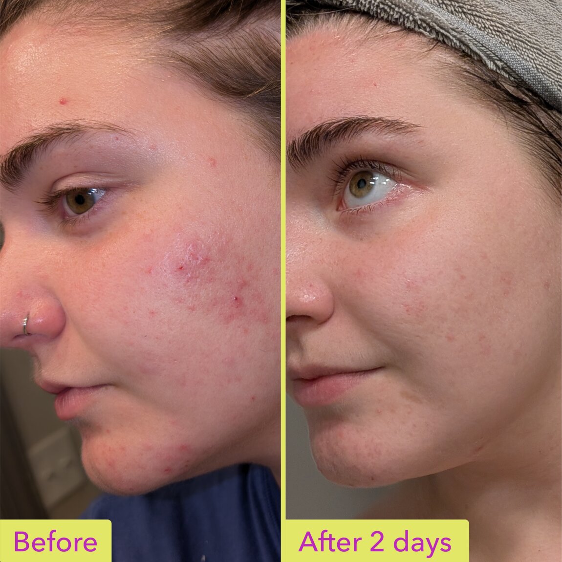 10% Azelaic Acid Treatment K6