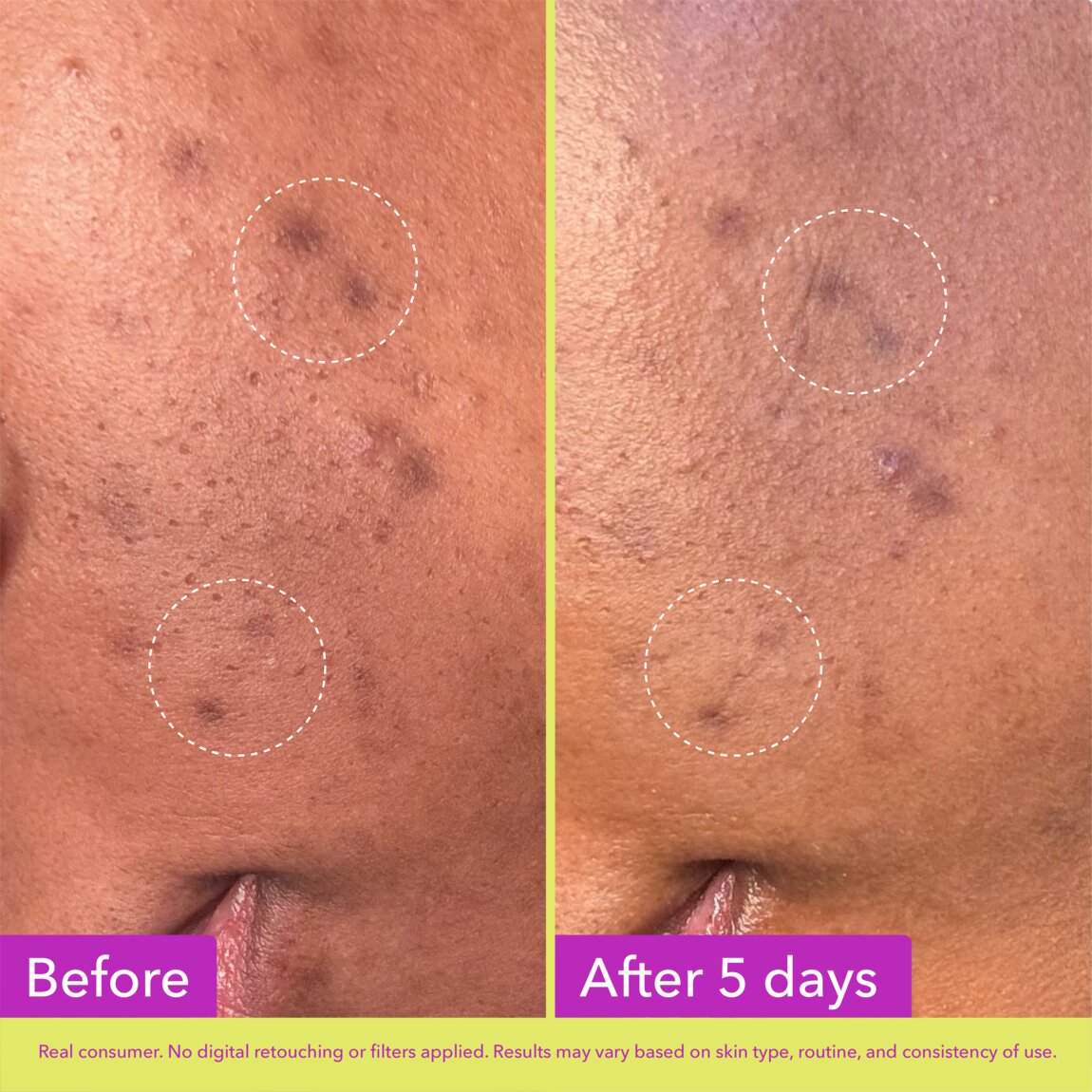Dark Spot Microdart Patches P6