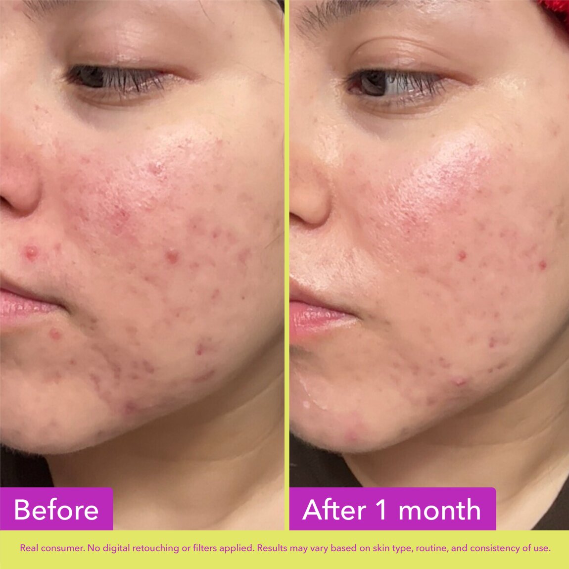 10% Azelaic Acid Treatment K6