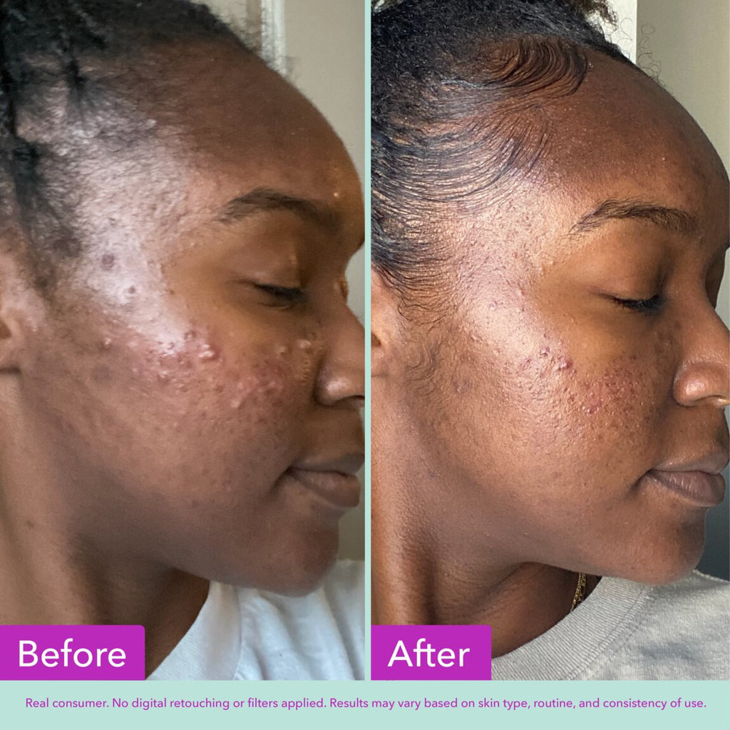 Acne Foaming Cleanser K6