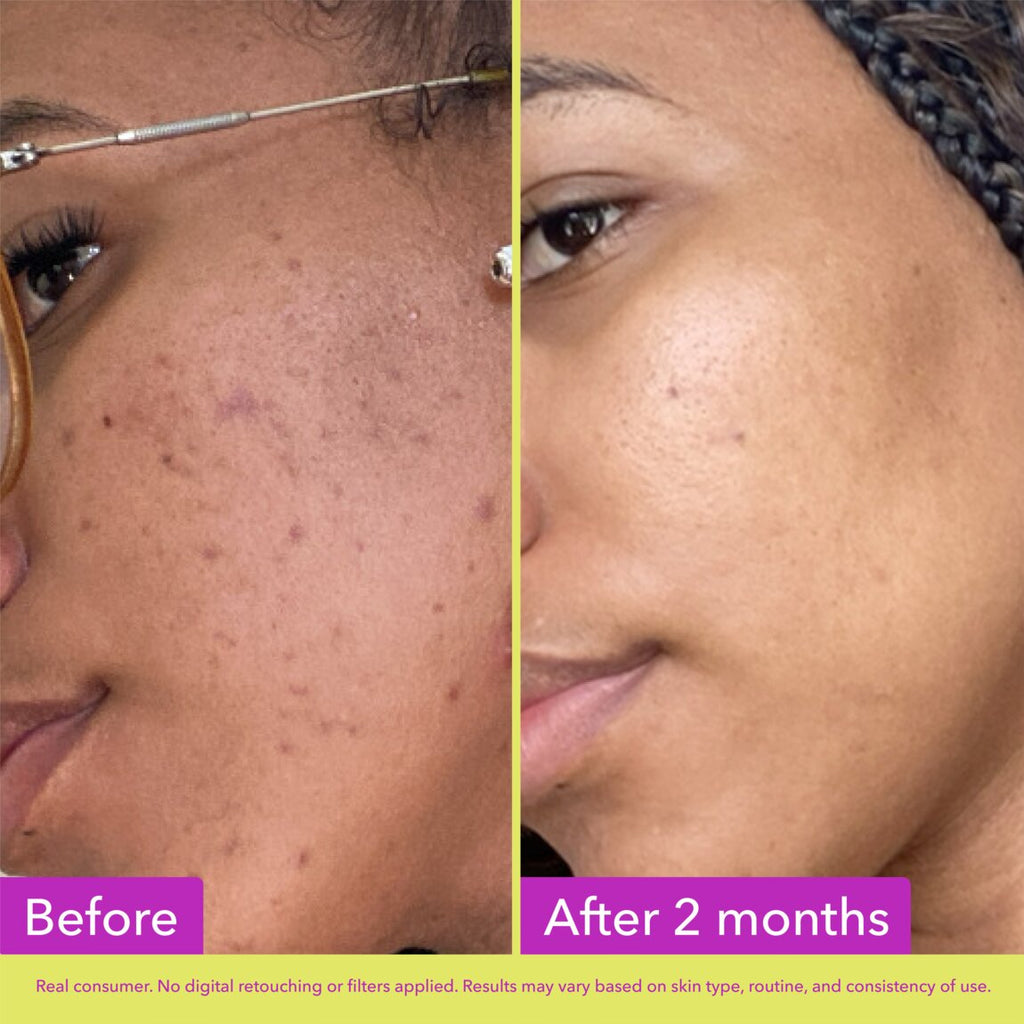 10% Azelaic Acid Treatment K6